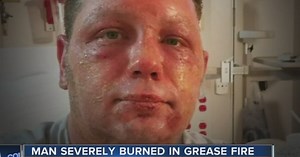 Man severely burned after grease fire in home