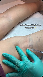 Sclerotherapy for Varicose Veins 🩵 Book an appointment now! Call or message 0917-127-4244 😊 #facials #peels #skinboosters #antiaging #whitening #acnescartreatment #wartsremoval #moleremoval #tatooremoval #faceandbodycontouring #varicoseveintreatment #surgicalprocedures | Nouvelle Clinic Face and Body Angeles City Branch