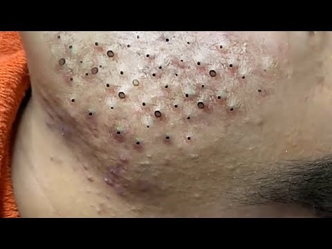Remove Hidden Blackheads On Neck