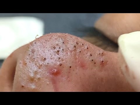 Suri Job #664: Awesome Inflamed Acne Extraction