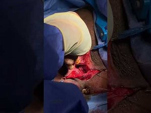 VAGINOPLASTY PERINEOPLASTY ( VAGINA TIGHTENING SURGERY) | London UK | Centre for Surgery