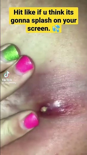 MASSIVE pimple popping | large blackheads | extreme pimple pop | cyst & acne |pimplepop 2022