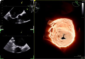 Vivid™ 9VT-D : World first mini 3D TEE probe. Designed for a broad range of pediatric and interventional procedures and for patients as small as 5 kg. Book your demo today! - All 2D, 4D, Color and Doppler modes - Cardiac, Pediatric and Coronary applications - Scan depths down to 18 cm *The Information on this advertisement is aimed exclusively at Licensed Healthcare Practitioners. | GE HealthCare
