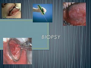 BIOPSY - SlideServe