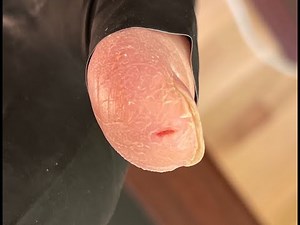 How to Prevent Finger Splits During Fall and Winter when the Air Moisture Content is Low