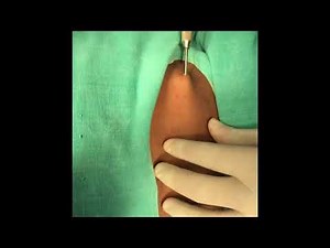 Fat injections in the hollow cheek @ Richardsons
