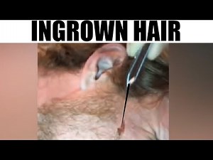 World's Longest Ingrown Hair, Biggest Cysts & Blackest Blackheads!