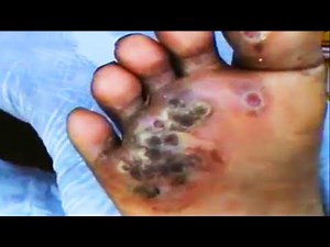 Big Jiggers Removed by Rise Up Society (Part One)