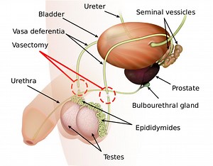 Safe, Effective Non-Scalpel Vasectomy | The Cooper Clinic