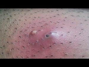 HOW TO REMOVE AN INGROWN HAIR DO THIS RIGHT NOW