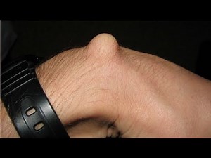 how to get rid of ganglion cyst on hand
