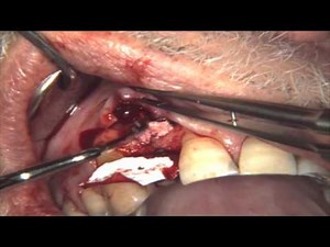 Implant Placement With Simultaneous Bone Augmentation - Case 2 • Video • MEDtube.net