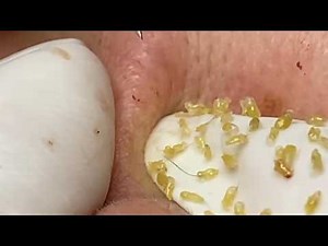 Extreme Acne Extraction | Giant Pimple Popping Compilation