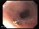 Gastric Cicatrization With Pylorus Stenosis (22 of 23) • Video • MEDtube.net