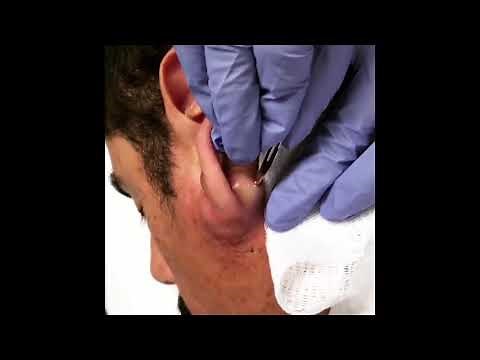 Best Cyst Popping Compilation 2019 (SATISFYING)