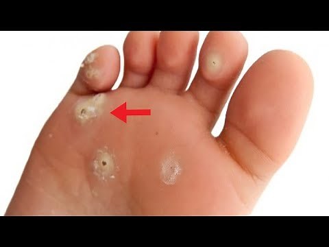 How to Get Rid of Corns on Toes Overnight - 5 Home Remedies for Corns and Calluses