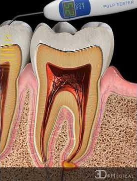 Electric Pulp Test High Response