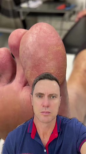 / docpods #callus #corn seed corn removal #footcorn #footskin #skinscrape #callusremoval #podiatrist #australia #satisfying #satisfy #asmr seed corns although small can be very very painful. Removal is painless and the relief is instant | Docpods