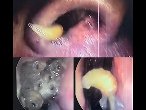 Maggots in Nose/ Nasal Myiasis- Dr. V. Narendrakumar