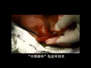 Shang Ring Male Circumcision video