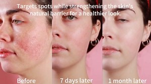 Dark Spot Remover for Face and Body Serum Promotes Anti-Aging Effect - Dark Spot Corrector for Women and Men with Niacinamide Kojic Acid & Salicyic Acid 50ml /1.7fl oz