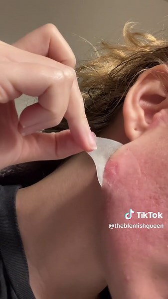 Discover Effective Pimple Patch Solutions for Cystic Acne