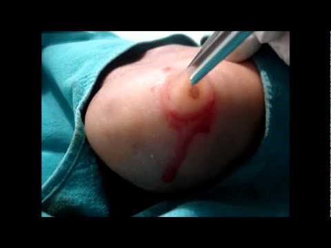 Complete Removal Of CALLUS in foot - IDEAL Treatment, Surgery. Watch out How to Remove-