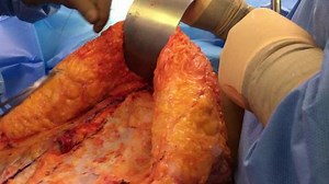 Tummy Tuck Tightening: Plication of Abdominal Muscles (GRAPHIC)