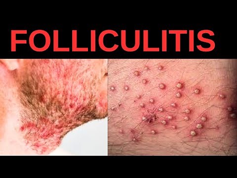 What is Folliculitis? Causes, Symptoms, Treatment