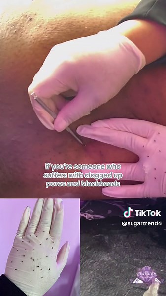 WHY DO I GET a lot of blackhead on my inner thighs ? ✨Friction ✨Sweat ✨hormonal imbalancement ➡️The Skin On Your Legs Contains thousands of pores . Can become clogged with bacteria or dead skin . What can cause a clogged pore is when the oil inside the clogged pore is exposed to air and it oxidizes and turns black . ➡️Finding the right products for your skin , to help remove the all the dead skin using a dry brush or a exfoliating glove ➡️This Service for those whose looking for skin lightening