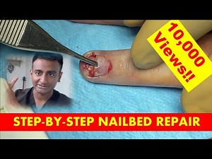 Expert Guide: Step-by-Step Surgical Nailbed Repair by a Consultant Plastic and Hand Surgeon