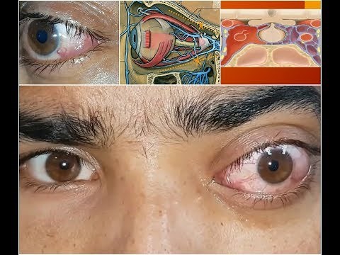 Pulsatile proptosis in a case of caroticocavernous fistula