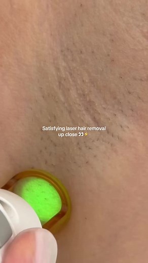 Laser hair removal up close: gentlemax pro plus view