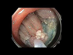 Colonoscopy: Cecum - Flat Lesion - EMR • Video • MEDtube.net
