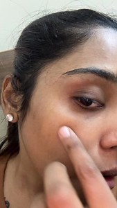 My Real Experience with Facial Hair Reduction – Meili Aesthetic Salon This treatment is not something I tried for promotion… I genuinely needed it. After pregnancy, I went through severe hormonal imbalance and I developed excess facial hair growth. No matter how many times I did threading or waxing, the hair kept coming back faster and thicker. It affected my confidence and I really wanted a better solution. That’s when I chose Facial Hair Reduction Laser Treatment at Meili Aesthetic Unisex Salo