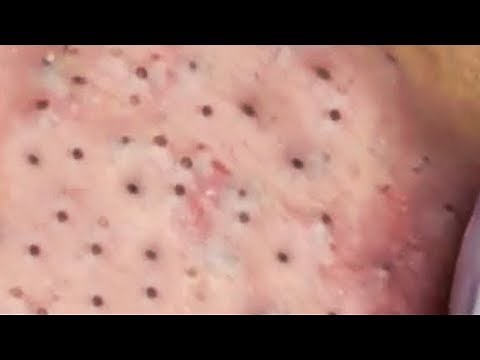 How To Remove Blackheads And Whiteheads On Face Easy #97 ✦ Dr Laelia ✦