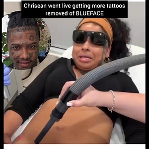 64K views · 137 reactions | #chrisean went live getting more tattoos removed of #BLUEFACE ‼️ | Fitty-Nation | Facebook