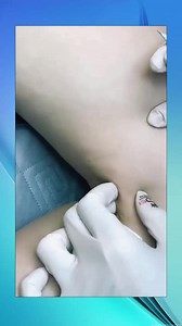 skincare# acne# extraction# squeeze# pimple# satisfying (145)