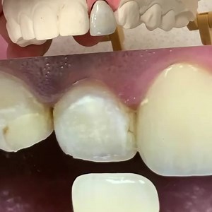 Single Monet Pure Zirconia Cemented Crown. Case from Dr. James Huseman in Indiana. | CEO Luke Kahng