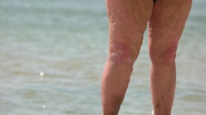 Close Up Legs of Retired Old Lady or Man with Varicosis. Stock Footage - Video of cellulite, woman: 285142584