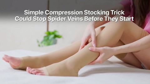 Simple Compression Stocking Trick Could Stop Spider Veins Before They Start