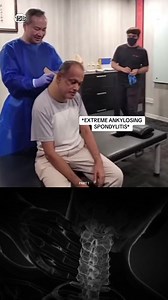 *EXTREME ANKYLOSING SPONDYLITIS* #chiropractic #chiropractor #quiropraxia #asmr | Quiroprax1