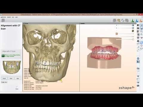 Digital Models Alignment with CT Scan (3Shape OrthoAnalyzer 2013)