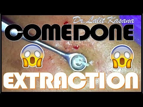 COMEDONE EXTRACTION / ANTI- ACNE THERAPY/ BLACKHEAD REMOVAL