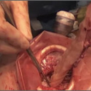 The Extracorporeal C-Incision Tissue Extraction (ExCITE) technique | MDedge