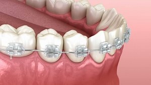 Mandibular jaw and Clear braces. Medically accurate dental 3D animation