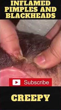 Giant Pimple Explosion Cyst Popping | Acne Pus Blackheads Bursting | ASMR Satisfying 24# 😱😱