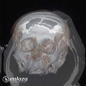 En el siguiente vídeo te presentamos como se ve un TAC de cerebro simple y el resultado en 3D La #tomografía computarizada (TC) utiliza un equipo especial de rayos X para ayudar a evaluar #lesiones en la cabeza, dolores de €cabeza severos, mareos, y otros síntomas de aneurisma, sangrado, derrame cerebral y tumores #cerebrales. En casos de #emergencia, puede identificar lesiones y hemorragias internas lo suficientemente rápido como para ayudar a salvar vidas. #EnlozaPtvjo #servicios #tacdecerebro