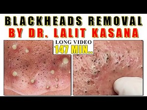 Christmas Gift / BLACKHEADS Removal By Dr.Lalit Kasana / 147 minutes long video