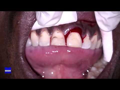 Luxation Replantation and Splinting